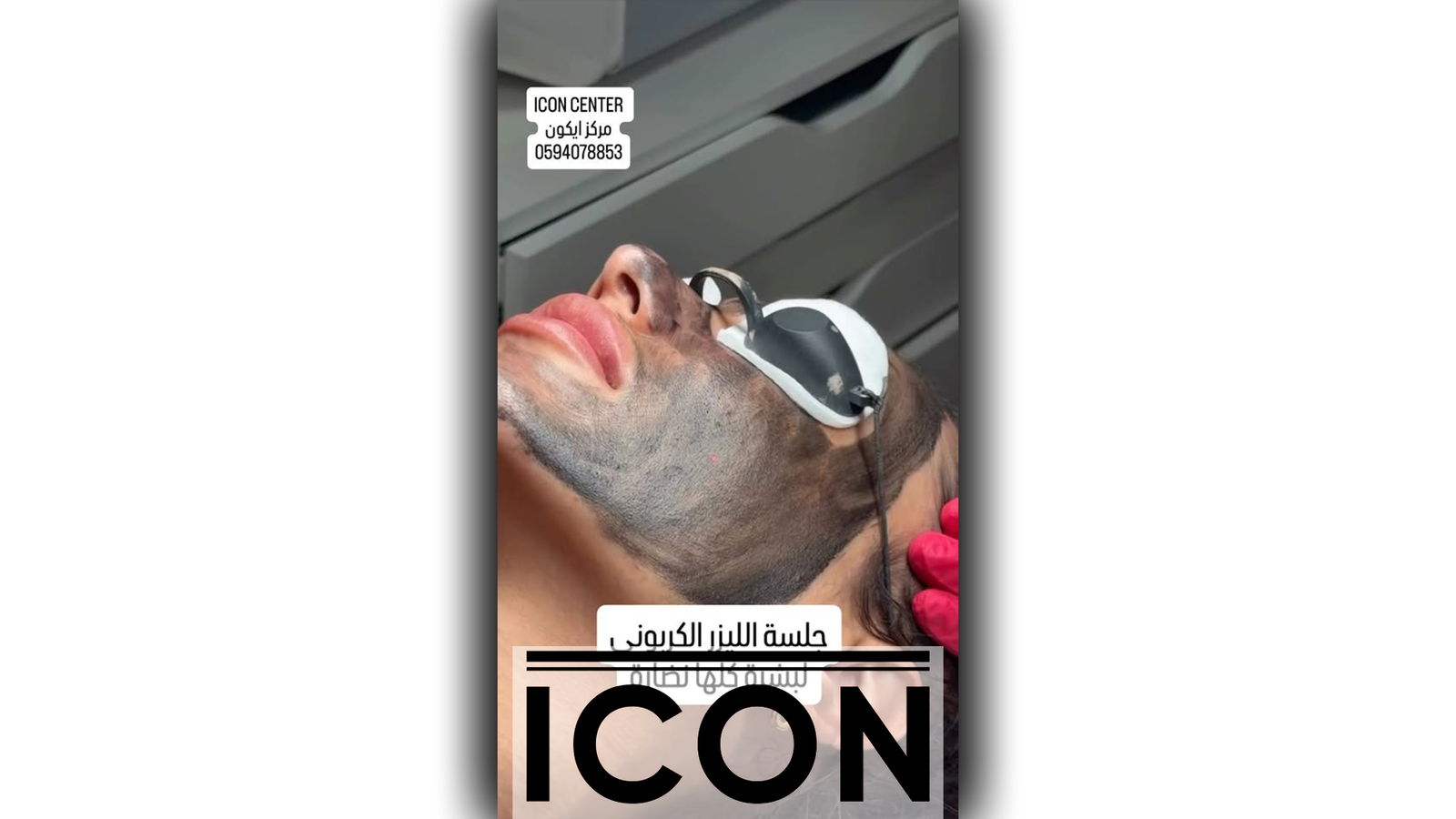 جلسة الليزر الكربوني