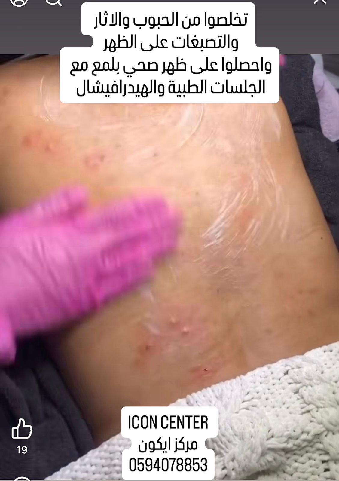 علاج وتنظيف جميع مشاكل الظهر والحبوب