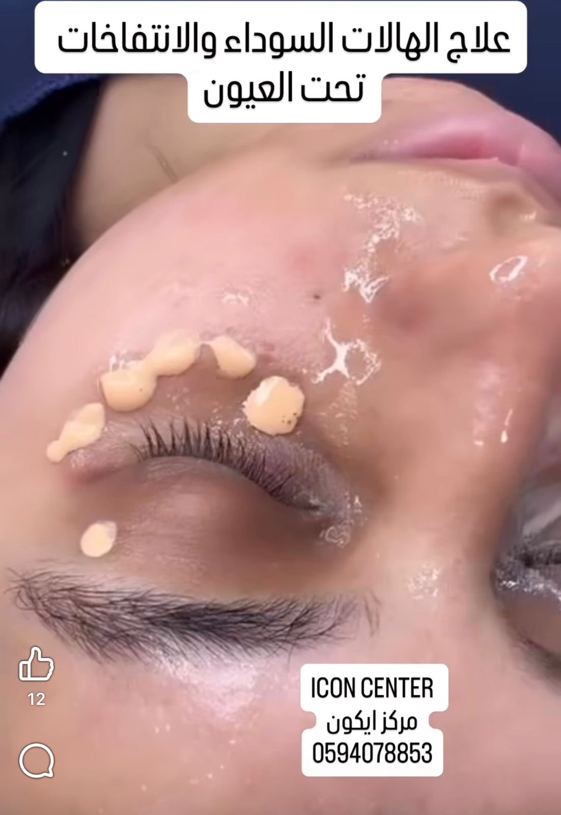 علاج الهالات السوداء وانتفاخات العيون