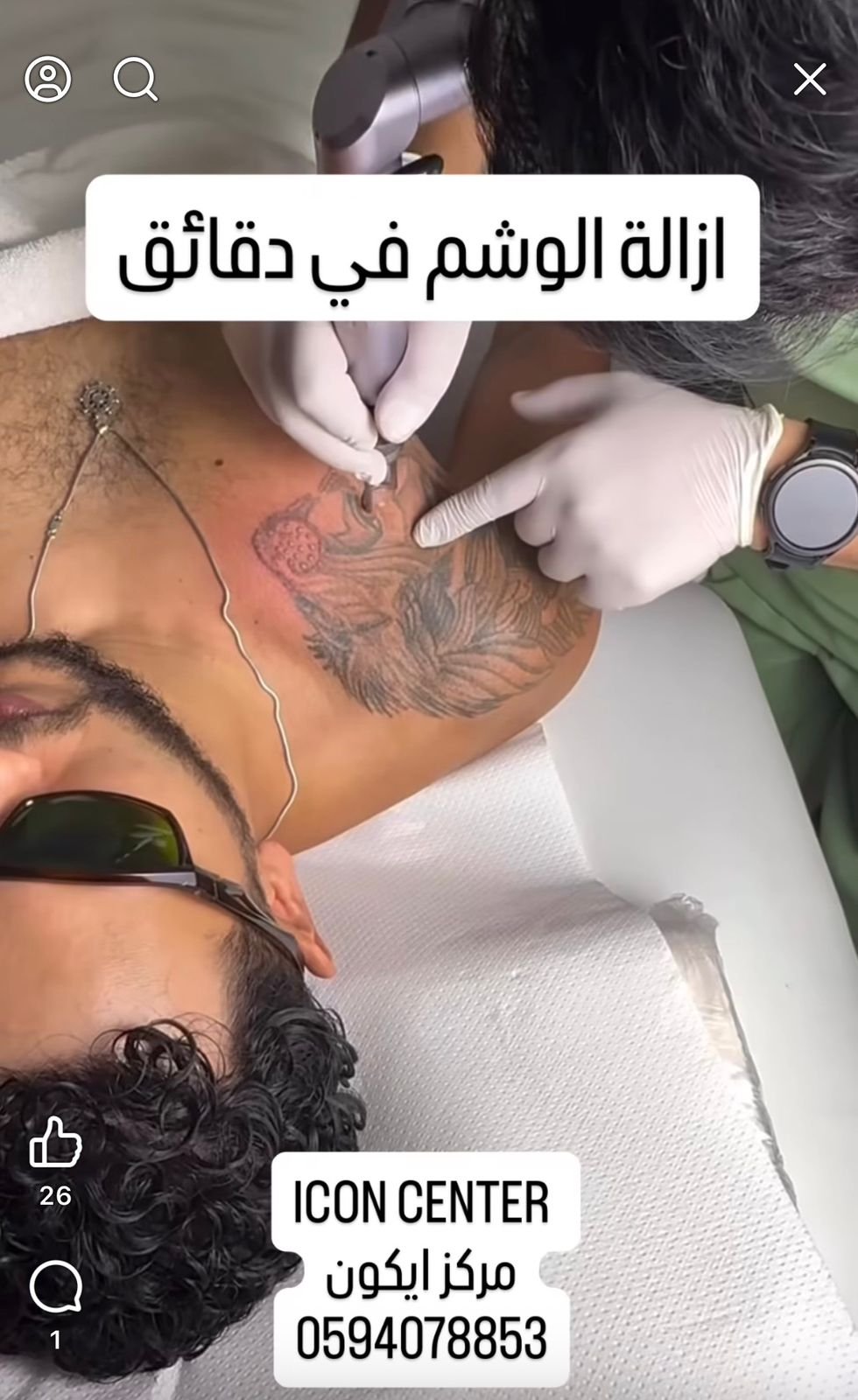 ازالة الوشم بالليزر