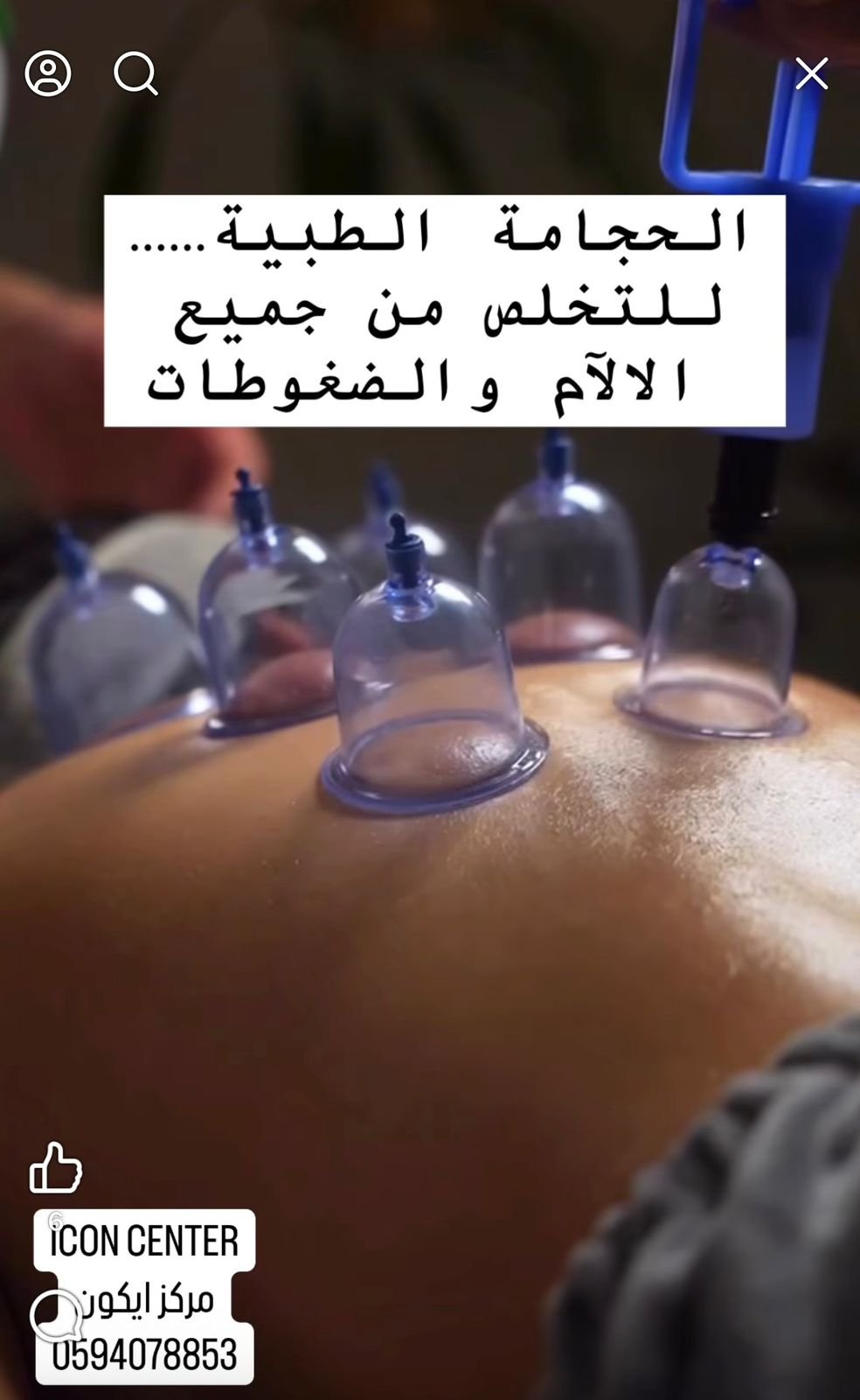 الحجامة الطبية