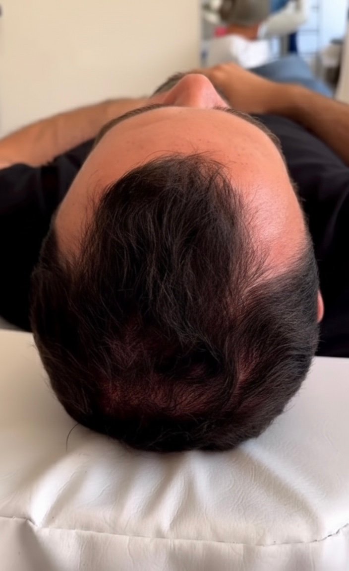 مشاكل تساقط وفراغات الشعر